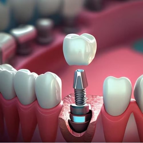 How Dental Implants Can Restore Your Smile and Confidence